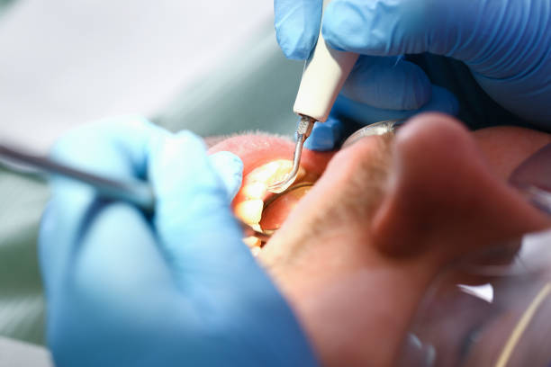 Best Emergency Treatment for Dental Infections or Abscesses in Perkasie, PA